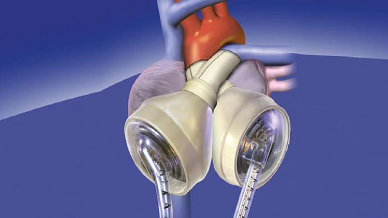 Bu bir ilk: Yapay kalple 100 gün hayatta kaldı